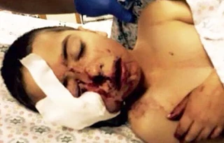 اصابة طفل برصاص الاحتلال فی العیسویة