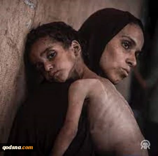سوء‌تغذیه شدید ۱۷ هزار کودک در غزه