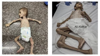 مرگ سه کودک غزه‌ بر اثر سندرم گیلن‌باره