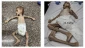 مرگ سه کودک غزه‌ بر اثر سندرم گیلن‌باره