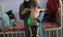 UNICEF: 112 Gazan children diagnosed with acute malnutrition every day